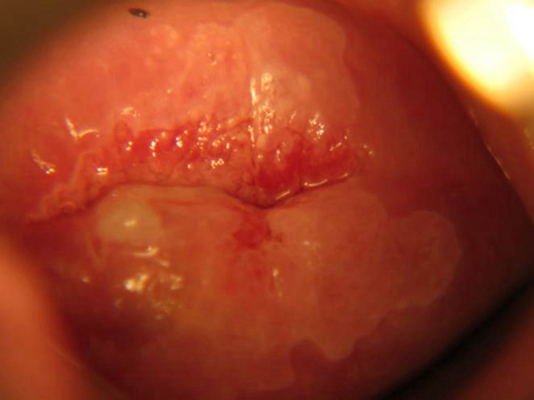淋病的癥狀及圖片介紹，淋病的癥狀詳解與圖片介紹