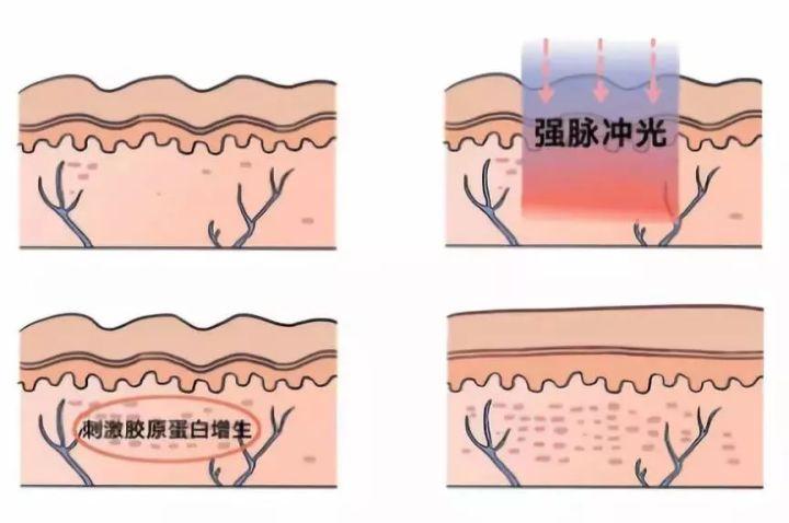 簡單有效的痘坑修復(fù)方法，讓你的肌膚重拾光彩，簡單有效的痘坑修復(fù)秘訣，重塑肌膚光彩！