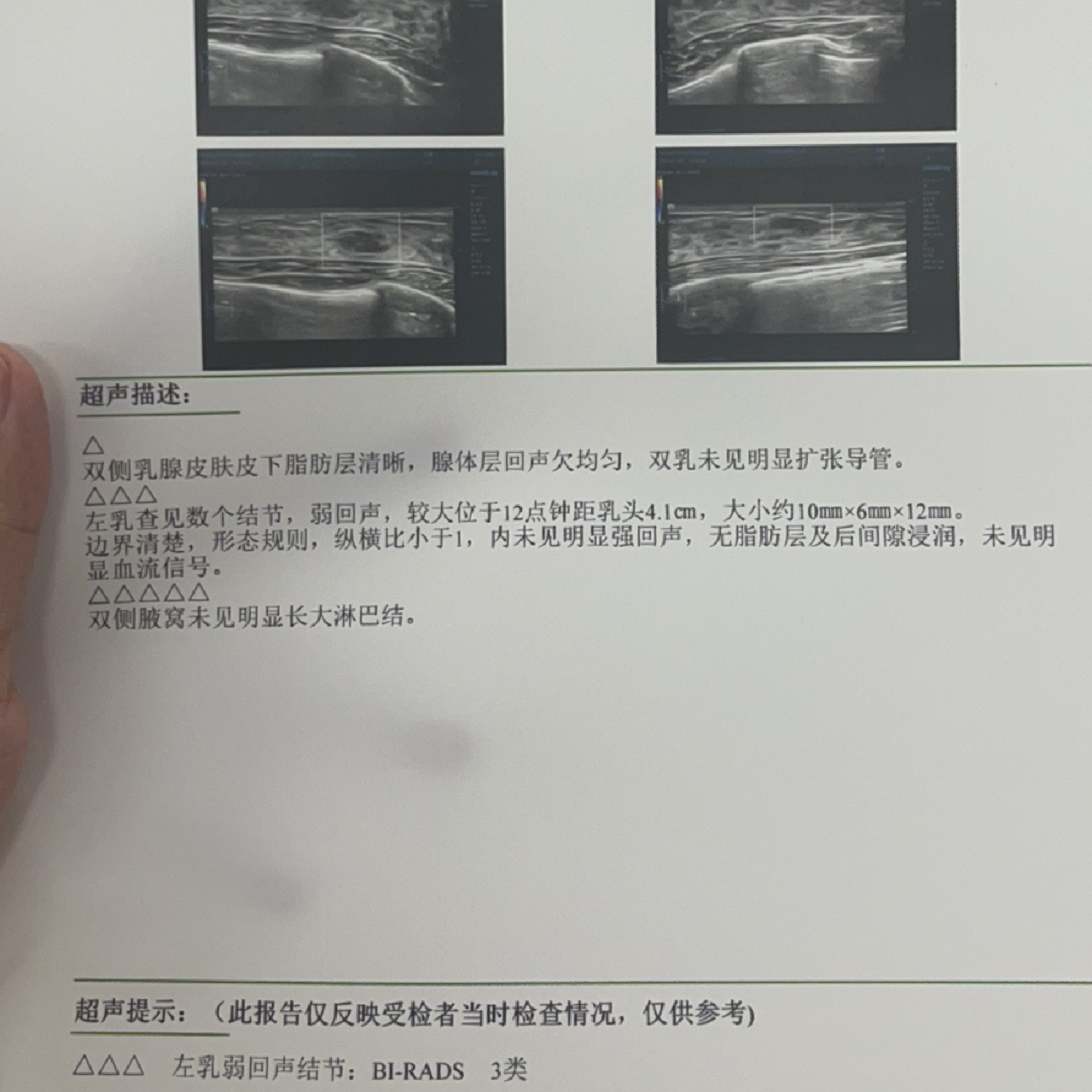 乳腺結(jié)節(jié)3類嚴(yán)重嗎？解讀乳腺健康，讓你了解真相，乳腺結(jié)節(jié)3類嚴(yán)重嗎？解讀乳腺健康真相