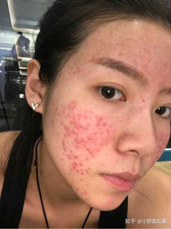 如何有效去除臉上的痘印——全方位指南，全方位指南，如何有效去除臉上痘印的方法