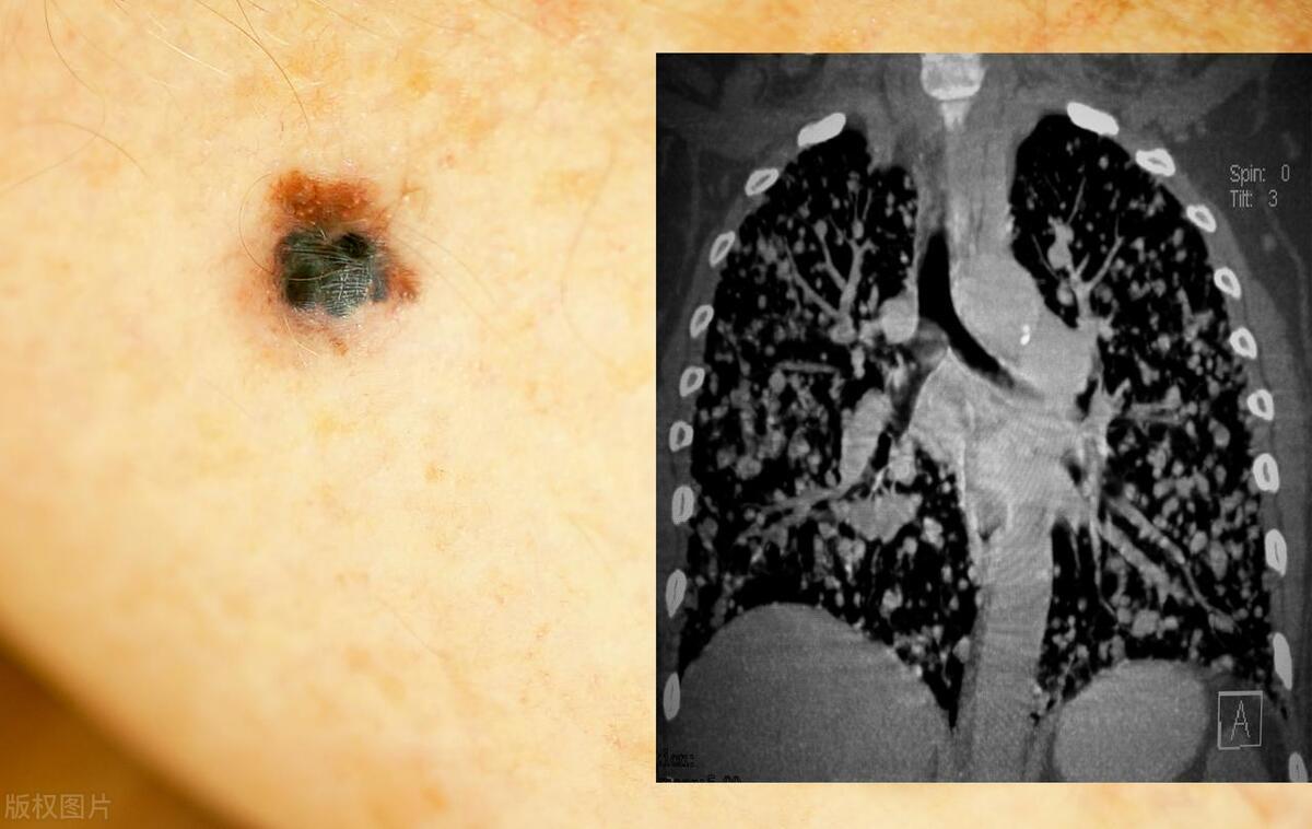 惡性黑色素痣初期的識別與應對，惡性黑色素痣初期識別與防治攻略