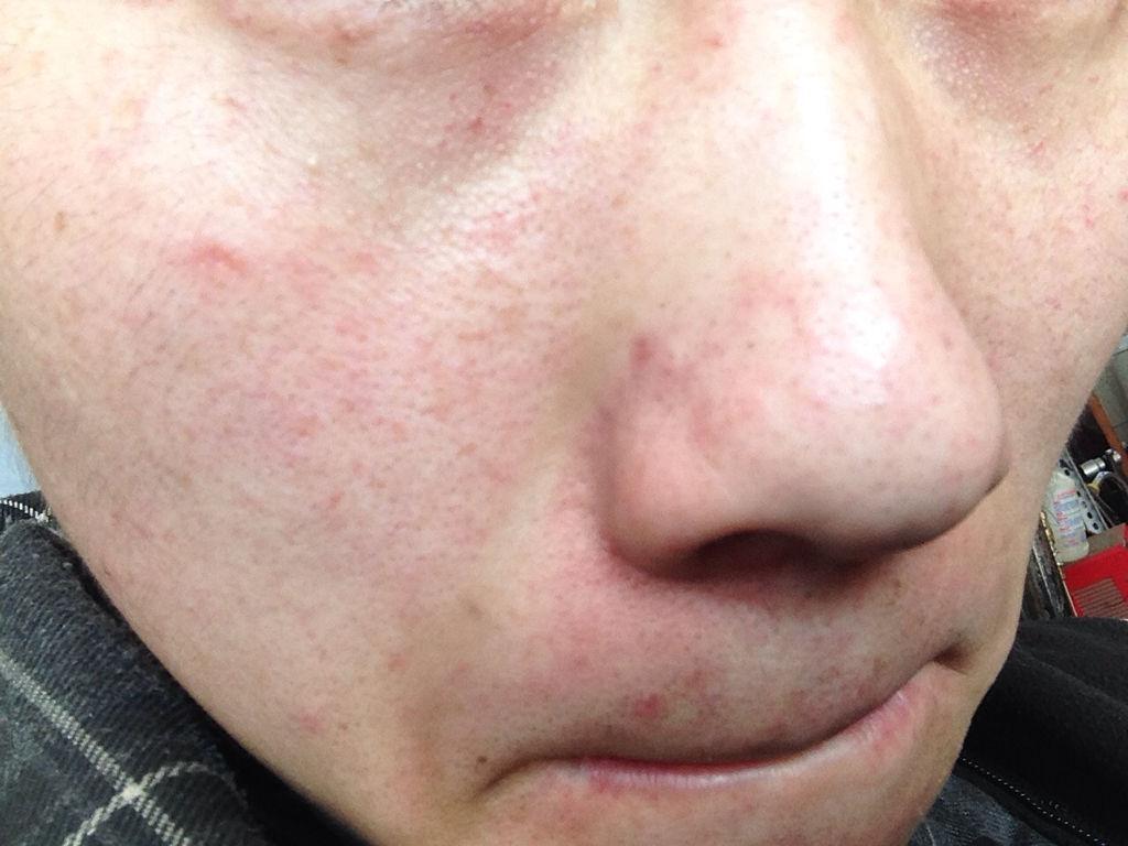 去掉臉上紅血絲的小妙招，消除臉部紅血絲的實(shí)用小妙招