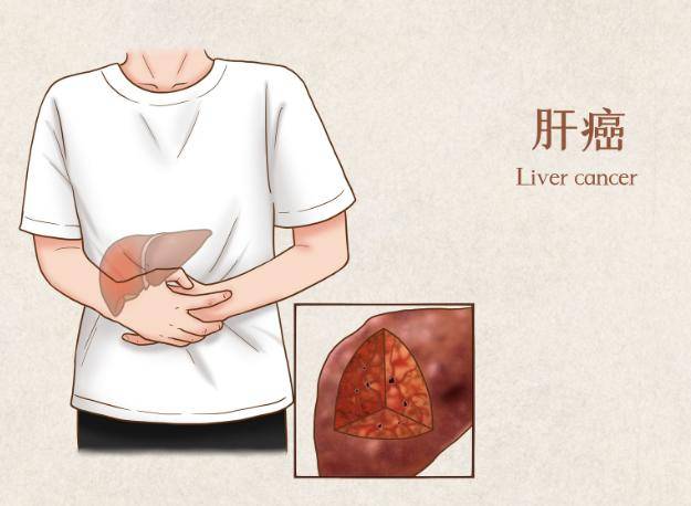 肝癌一般三處痛，癥狀解析與應(yīng)對策略，肝癌癥狀解析，疼痛位置、應(yīng)對策略及三處痛詳解