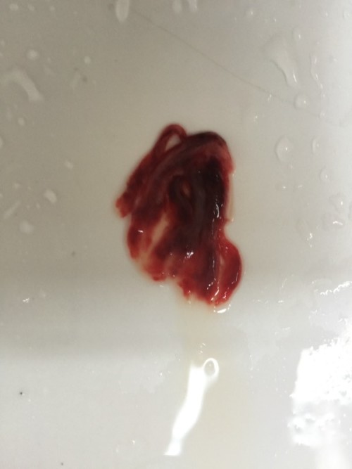 經(jīng)期排出淤血的技巧，優(yōu)化你的生理健康與生活質(zhì)量，經(jīng)期淤血排除技巧，提升生理健康與生活質(zhì)量之道