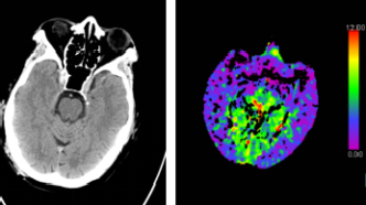 腦CT沒事就代表大腦沒事嗎？深入探討腦部健康與CT檢查的關系，腦部健康與CT檢查，CT無異常是否代表大腦無隱患？