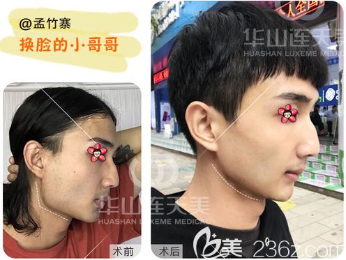 削顴骨手術費用詳解，手術費用大概要多少錢？，削顴骨手術費用詳解，手術費用及預算指南