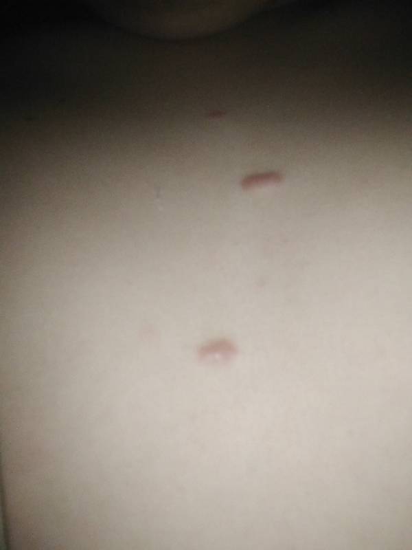 下面長了一個硬疙瘩一碰就疼，原因、診斷與治療方法，私密部位硬疙瘩，成因、診斷與治療方法