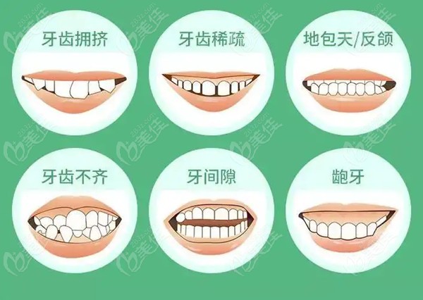 牙齒正畸費(fèi)用詳解，一般多少？，牙齒正畸費(fèi)用全面解析，了解一般價格及影響因素