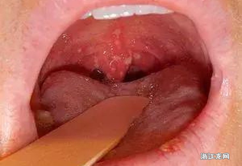 皰疹性咽峽炎五個(gè)分期詳解，皰疹性咽峽炎的五個(gè)分期詳解及特點(diǎn)解析