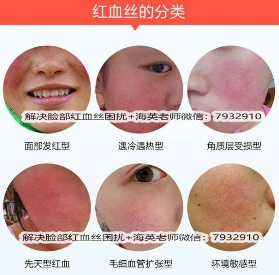 臉上出現(xiàn)紅血絲怎么治療，全面解析有效方法，臉上紅血絲全面解析與有效治療方法