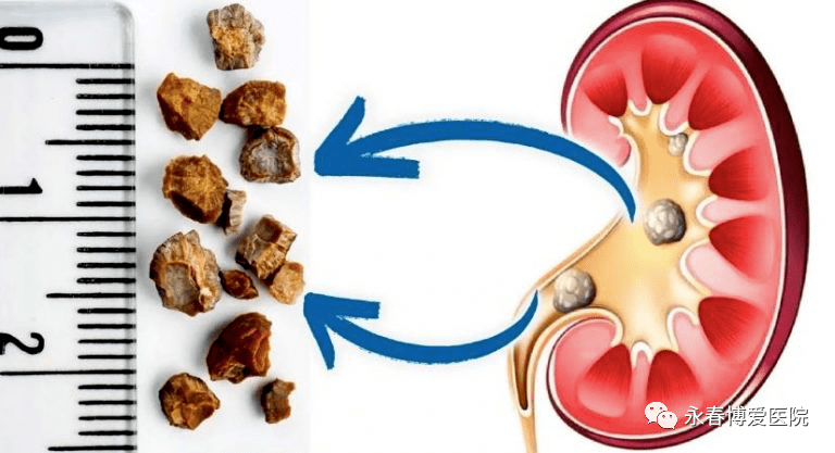 腎結(jié)石的最好治療方法有哪些，腎結(jié)石的最佳治療方法介紹