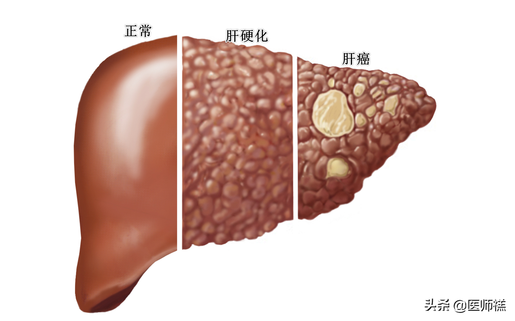 早期硬化的肝能治愈嗎，全面解析與希望，早期肝硬化能否治愈，全面解析與預(yù)后展望