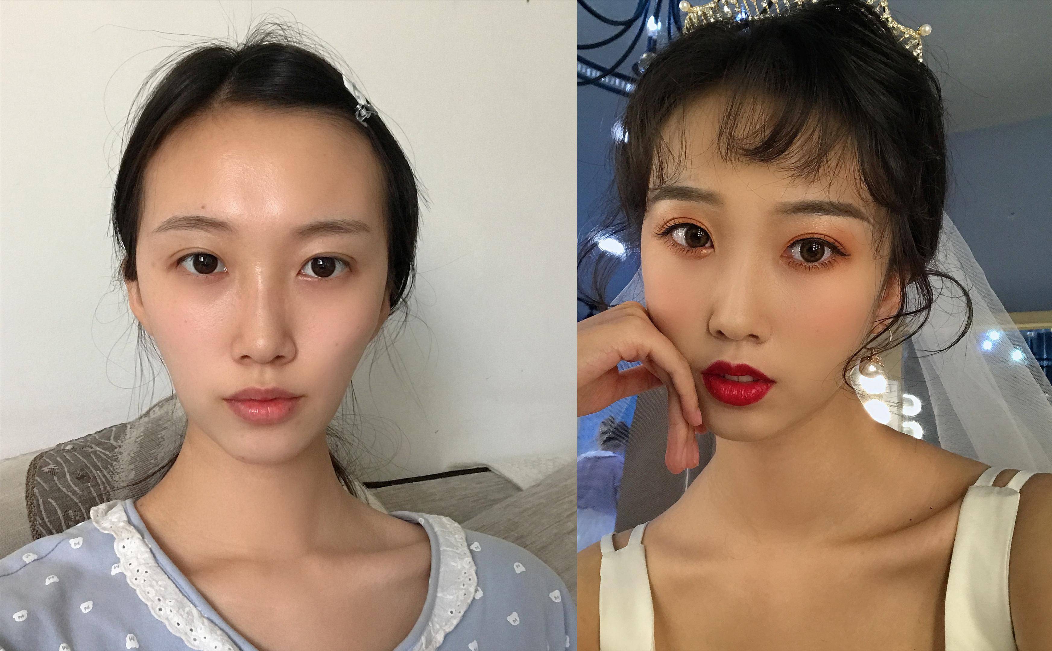 自體填充脂肪，利弊分析，自體脂肪填充的利弊分析