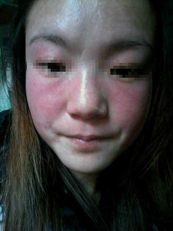 如何去掉黃褐斑的最好辦法，如何有效去除黃褐斑的方法探究
