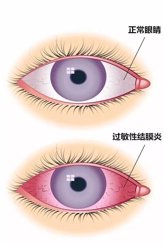 過敏性結(jié)膜炎，癥狀、原因及防治策略，過敏性結(jié)膜炎詳解，癥狀、成因與防治策略