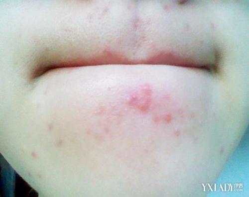 下巴周圍反復長痘痘的原因及解決方法，下巴周圍反復長痘成因與解決策略