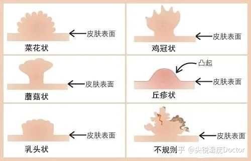 女性如何自己判斷真假尖銳濕疣？，女性如何自主辨別真假尖銳濕疣？