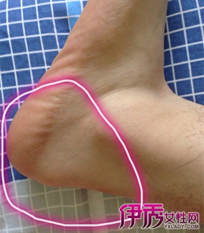 腳后跟疼的原因及治療方法，全面解析與應(yīng)對(duì)之道，腳后跟疼痛解析，成因、治療方法與應(yīng)對(duì)之道