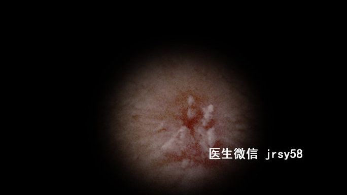 尖銳濕疹，深入了解與治療建議，尖銳濕疹，深度解析與治療指南