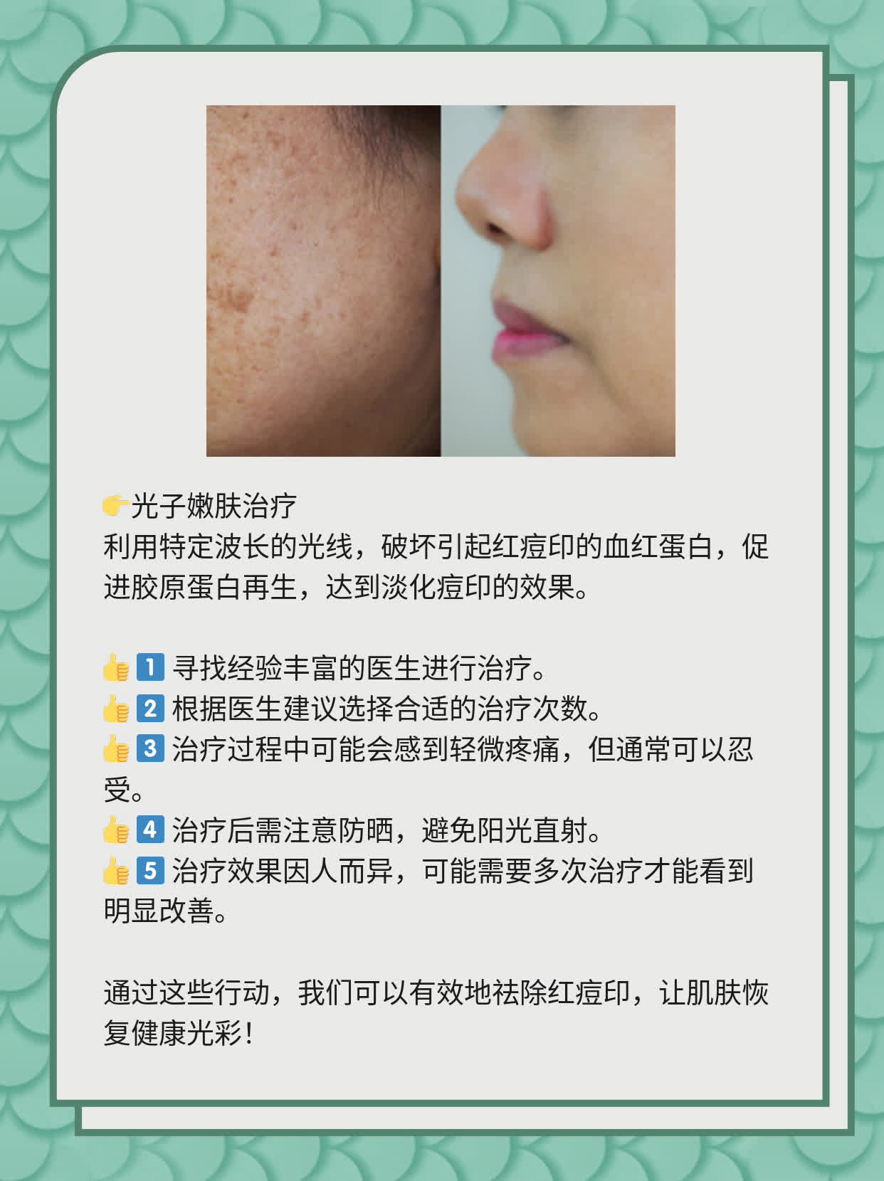 如何有效去除紅痘印，一站式解決方案，一站式解決紅痘印問(wèn)題，有效去除方法大全