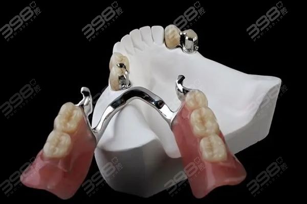 鑲一顆牙大概需要多少錢——全面解析鑲牙費用因素，鑲一顆牙的費用解析，全面探討鑲牙費用因素及大概價格