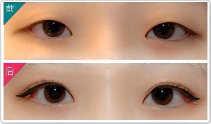 割雙眼皮多少錢呢？全面解析雙眼皮手術(shù)費(fèi)用因素，雙眼皮手術(shù)費(fèi)用全面解析，了解割雙眼皮的價格與影響因素