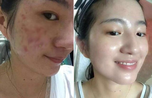 痘印多久會(huì)自己消失？全面解析痘印消失時(shí)間與影響因素，痘印消失時(shí)間全面解析，影響因素與消失時(shí)長(zhǎng)探討