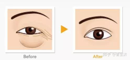 尋找最佳的眼袋治療醫(yī)院，專(zhuān)業(yè)解析與推薦，專(zhuān)業(yè)解析眼袋治療醫(yī)院推薦，助您尋找最佳治療機(jī)構(gòu)