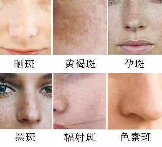 如何有效去除臉上斑點(diǎn)——全方位指南，全方位指南，如何有效去除臉上斑點(diǎn)