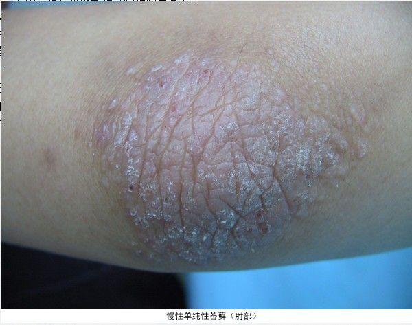 牛皮膚癬怎么根治，全面解析與有效治療策略，全面解析牛皮膚癬的根治方法與有效治療策略