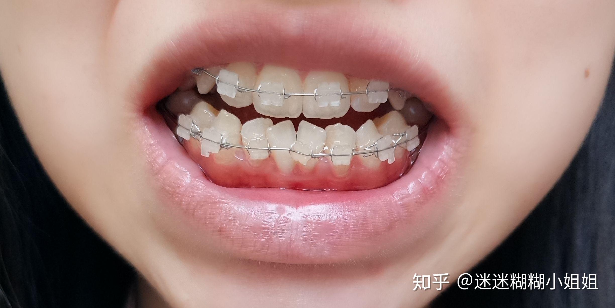 矯正牙齒的黃金時期與成年后的選擇，探討36歲矯正牙齒的必要性，矯正牙齒的黃金時期與成年后的選擇，探討矯正牙齒的必要性至36歲