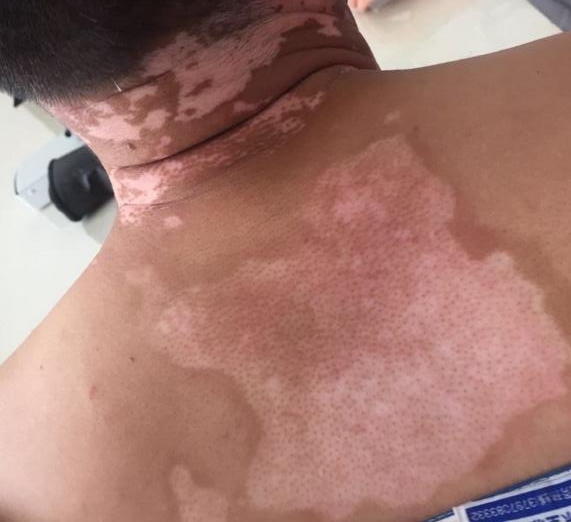 什么樣的白斑不用治——深入了解白斑的多種可能性，白斑的多種可能性解析，哪些白斑無需治療？