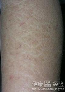 魚(yú)鱗皮膚病如何才能根治，全面解析與應(yīng)對(duì)策略，全面解析魚(yú)鱗皮膚病根治之道，應(yīng)對(duì)策略大揭秘