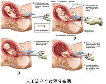 人流半個(gè)月后是否可以帶套進(jìn)行性行為？解析與注意事項(xiàng)，人流半個(gè)月后帶套性行為解析及注意事項(xiàng)