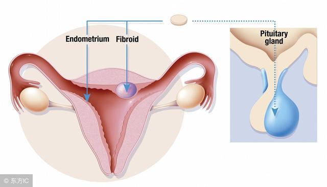 子宮肌瘤會自己消失嗎？解析子宮肌瘤的發(fā)展與消退可能性，子宮肌瘤的發(fā)展與消退可能性解析，能否自行消失？
