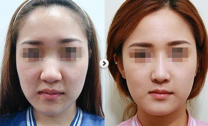 日常方法縮小鼻翼——實用指南，實用指南，日常方法縮小鼻翼