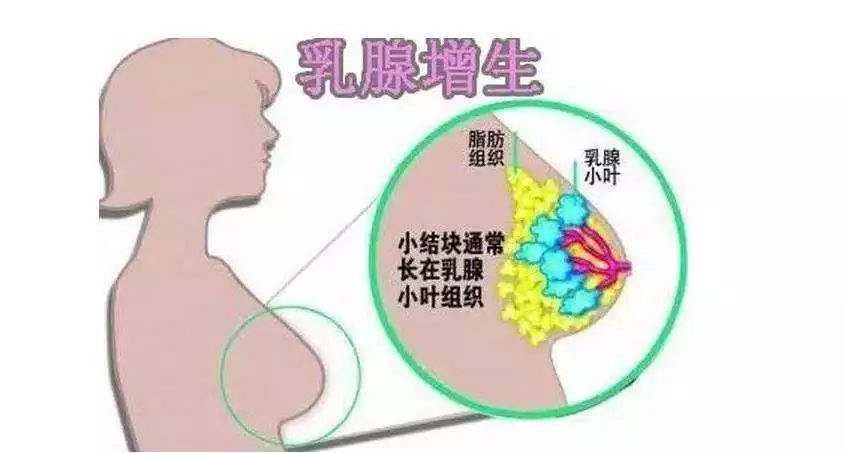 乳腺增生常做四個動作，預(yù)防與緩解的關(guān)鍵，乳腺增生預(yù)防與緩解的關(guān)鍵，四個動作助你健康護理