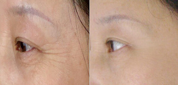 打除皺針一般價格解析，因素、市場行情及預算考量，打除皺針的價格解析，市場行情、影響因素與預算考量全知道