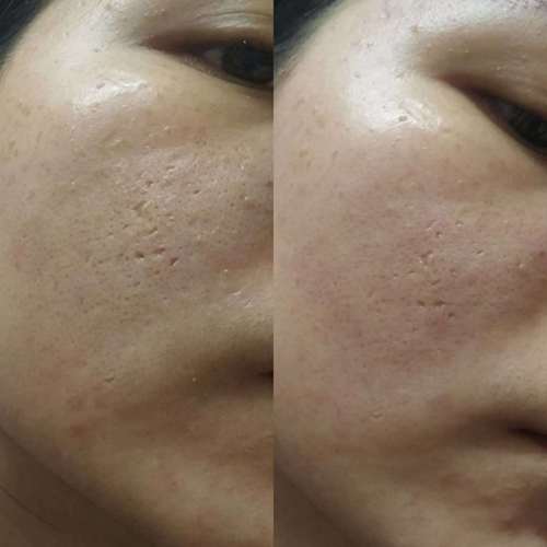 祛痘坑最好的方法，目前最有效的解決方案，最有效的祛痘坑方法，當(dāng)前最受歡迎的解決方案