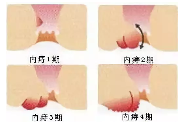 怎樣判斷自己是否患有痔瘡？全面解析與指導(dǎo)，如何判斷自己是否患有痔瘡？詳細(xì)解析及指導(dǎo)指南