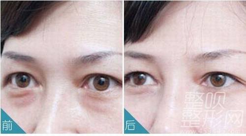 眼袋最好的根治方法，重塑明亮雙眼的秘訣，重塑明亮雙眼，眼袋根治秘訣揭曉