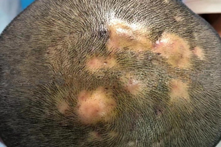 毛囊炎硬疙瘩圖片，了解、識別與治療，毛囊炎硬疙瘩詳解，識別圖片、了解與治療