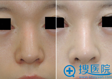 鼻子整容需要多少費(fèi)用，全面解析費(fèi)用因素與影響因素，鼻子整容費(fèi)用全面解析，費(fèi)用因素與影響因素探討