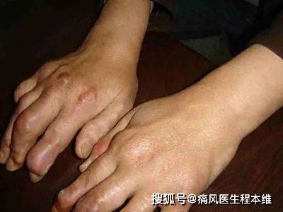 類(lèi)風(fēng)濕手指疼痛首發(fā)部位解析，哪個(gè)手指會(huì)先疼？，類(lèi)風(fēng)濕手指疼痛解析，首發(fā)部位及預(yù)測(cè)哪個(gè)手指先疼？