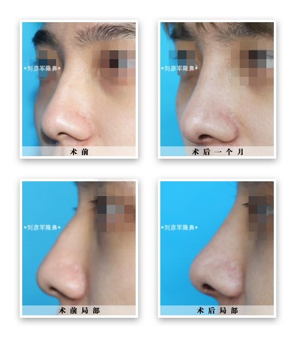 縮鼻頭，改善鼻子外觀的有效方法，縮鼻頭技巧，有效改善鼻子外觀的方法