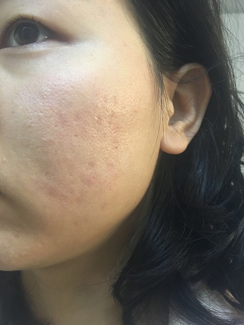 嚴重痤瘡治療最徹底的方法，全面攻略與最佳實踐，全面攻略揭秘，最徹底治療嚴重痤瘡的最佳實踐與最佳方法