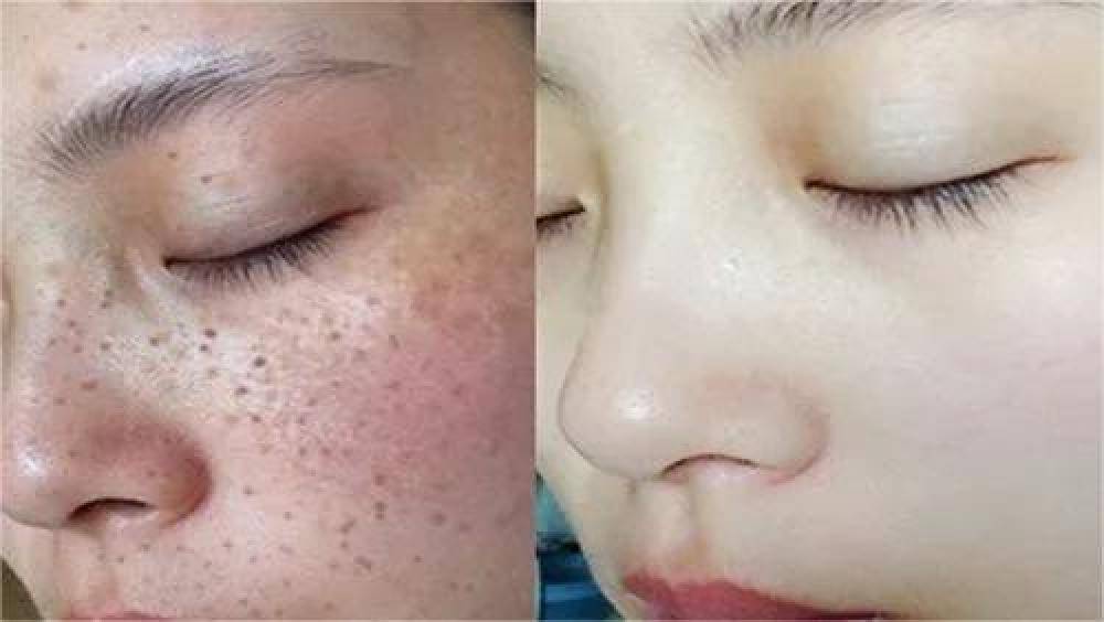 哪種祛斑方法最有效不反彈，全面解析最有效的祛斑途徑，全面解析，最有效的祛斑方法，不反彈之選！
