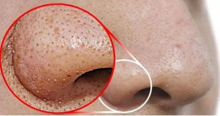 孩子身上起螨蟲疙瘩圖片，了解、預(yù)防與治療，孩子身上的螨蟲疙瘩，圖片、預(yù)防與治療全攻略