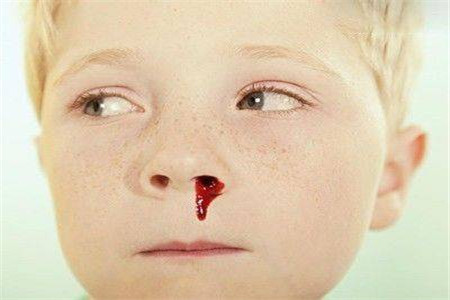 兒童白血病流鼻血的特點及其重要性，兒童白血病流鼻血特征與重要性解析