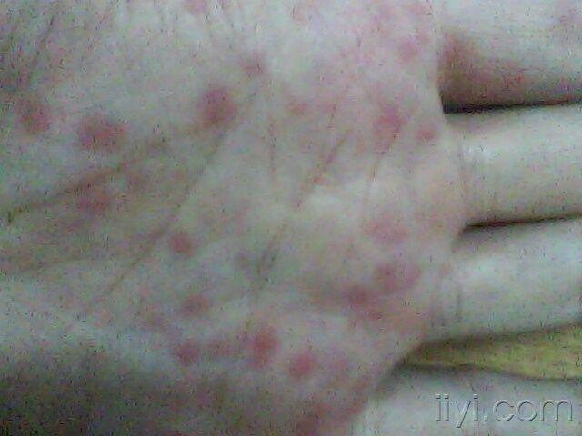 關(guān)于梅毒引發(fā)的紅斑特征及識別方法，梅毒引發(fā)紅斑的特征與識別方法指南